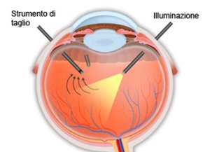 Distacco di retina 2